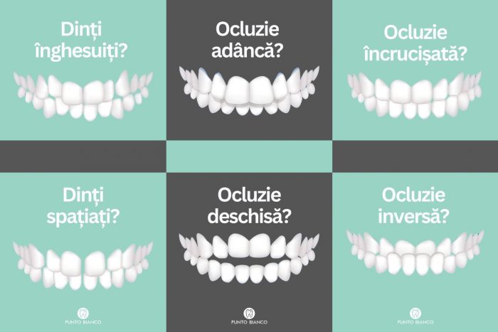 Probleme de ocluzie (mușcătură) care le poate rezolva ortodontul clinicii Punto Bianco Chișinău