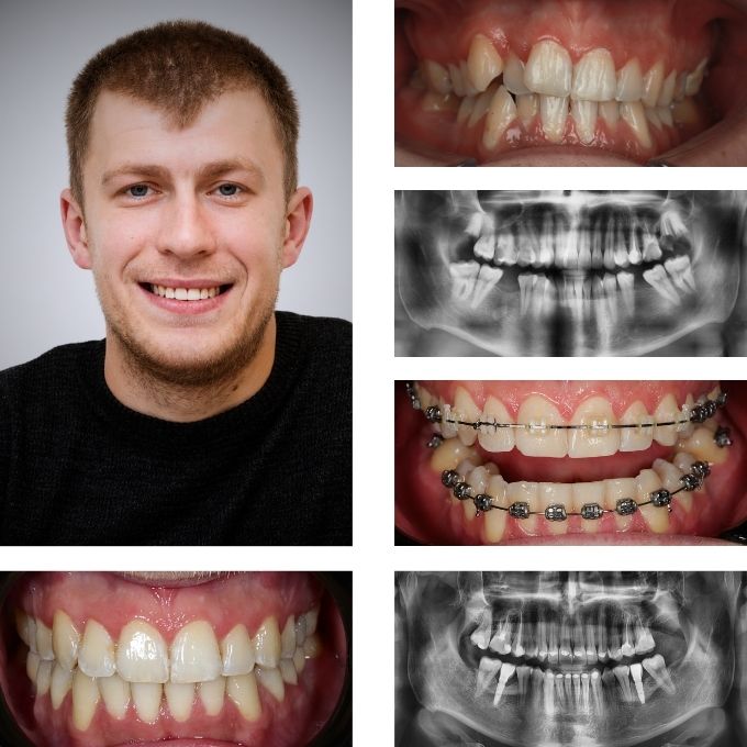 Tratament ortodontic cu bracketi, urmat de implanturi dentare și protezare, pentru corectarea înghesuirii dentare și refacerea spațiului pierdut