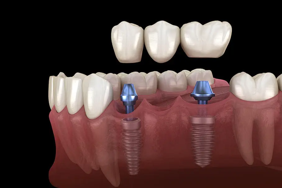 Coroană pe implant dentar – Punto Bianco