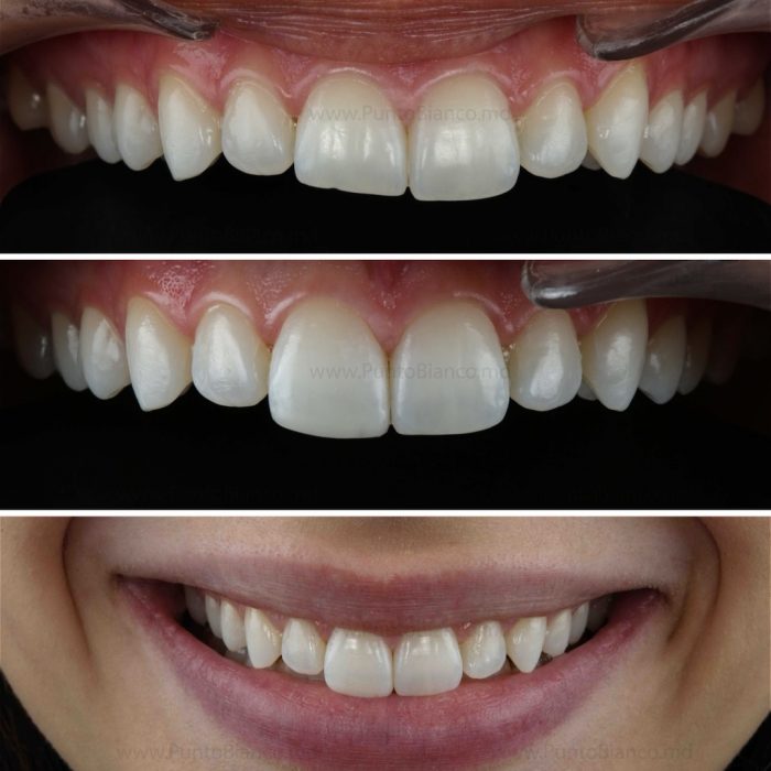 colaj foto înainte și după restaurari dentale din compozit la Punto Bianco Chișinău