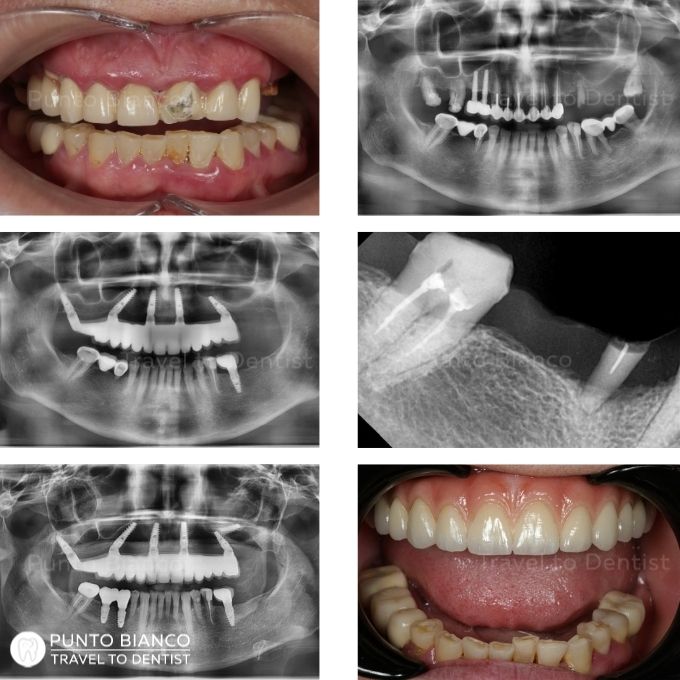 Exemplu de tratament cu implante dentare efectuat pe etape
