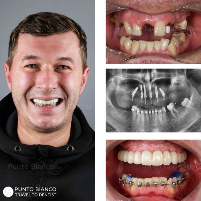 proteza provizorie fp1 (fara gingie artificiala) pe 6 implanturi dentare