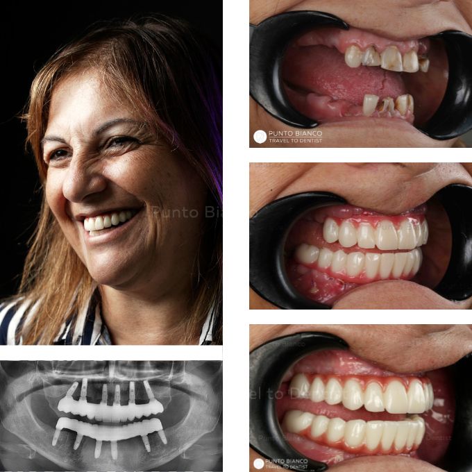 Lucrare cu proteza all on x din zirconiu monobloc