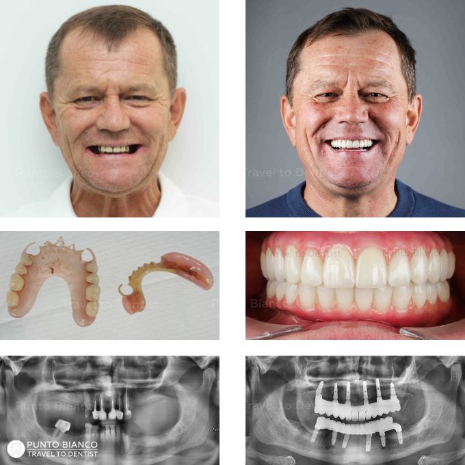 Reabilitare dentară completă în Moldova pentru pacient din Italia, de la proteze mobile vechi la dinți ficși pe implanturi