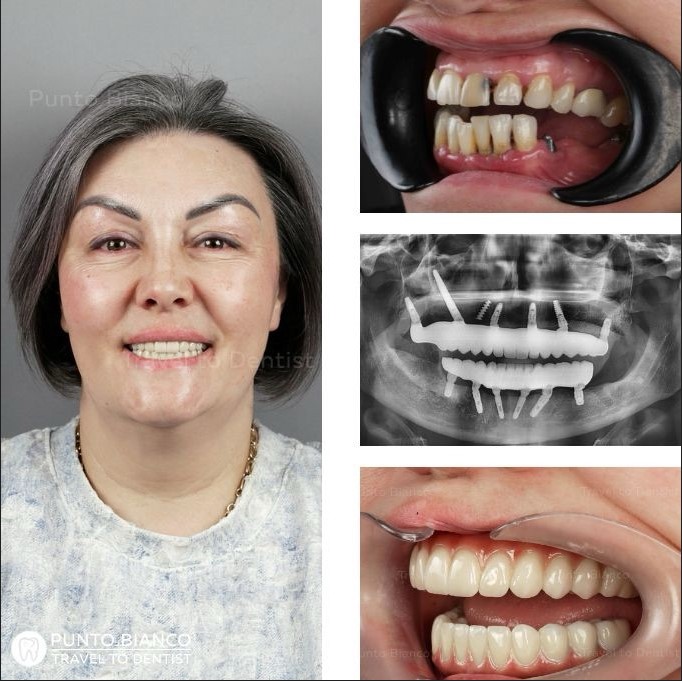 Impianti dentali tutta la boca