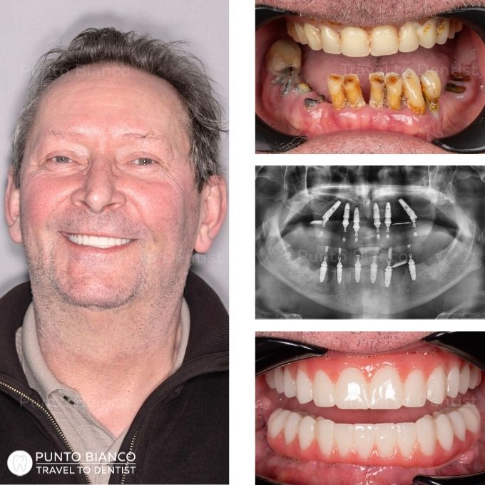 Înainte și după All-on-6 cu lucrare provizorie fixă la Punto Bianco, turism dentar în Moldova