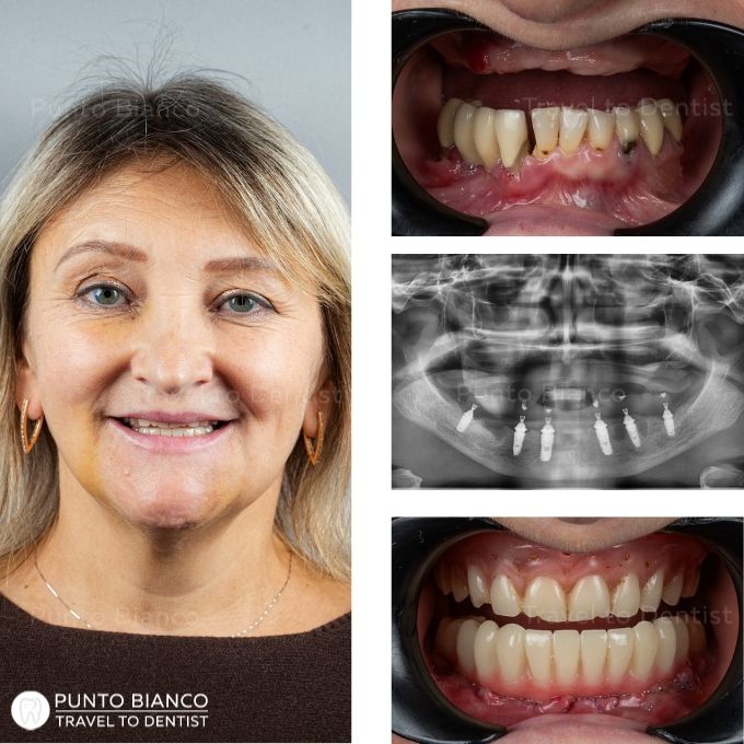 Pacientă din diaspora, originară din Ucraina și stabilită în Italia, tratată în Moldova cu dinți ficși provizorii pe implanturi la mandibulă, în 24 de ore