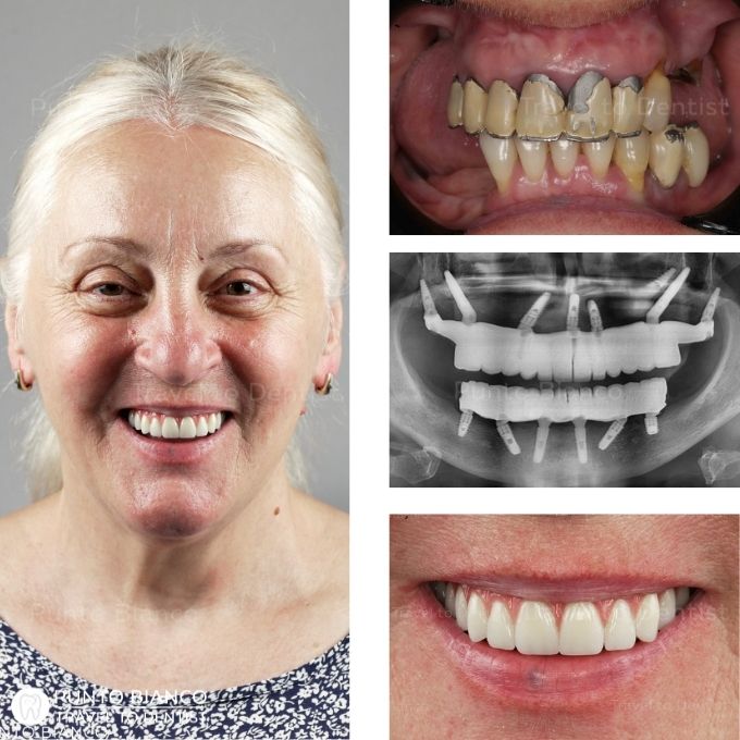 inainte si dupa reabilitare totala pe implanturi speciale