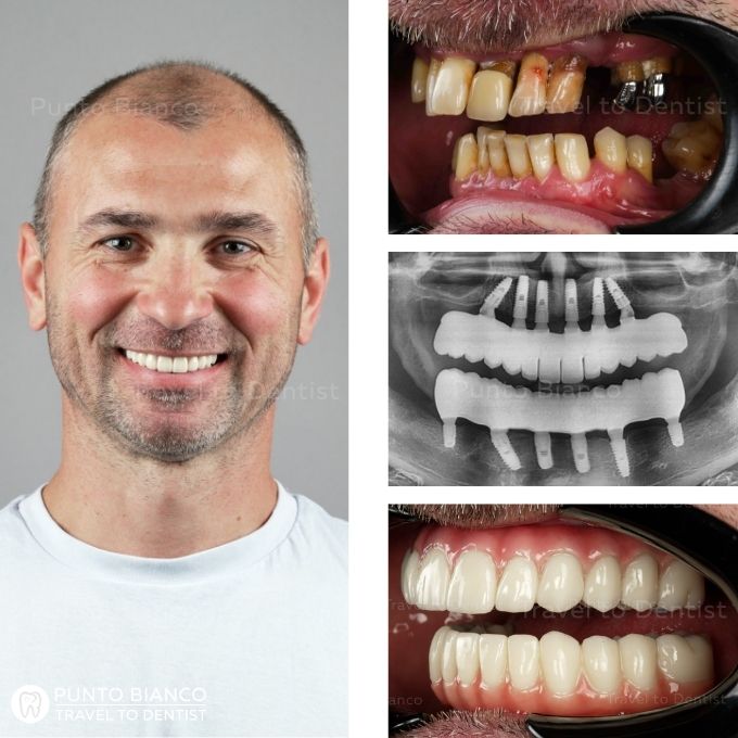 Tratamiento con prótesis ALL on X de zirconio ECO reforzada con barra de CrCo