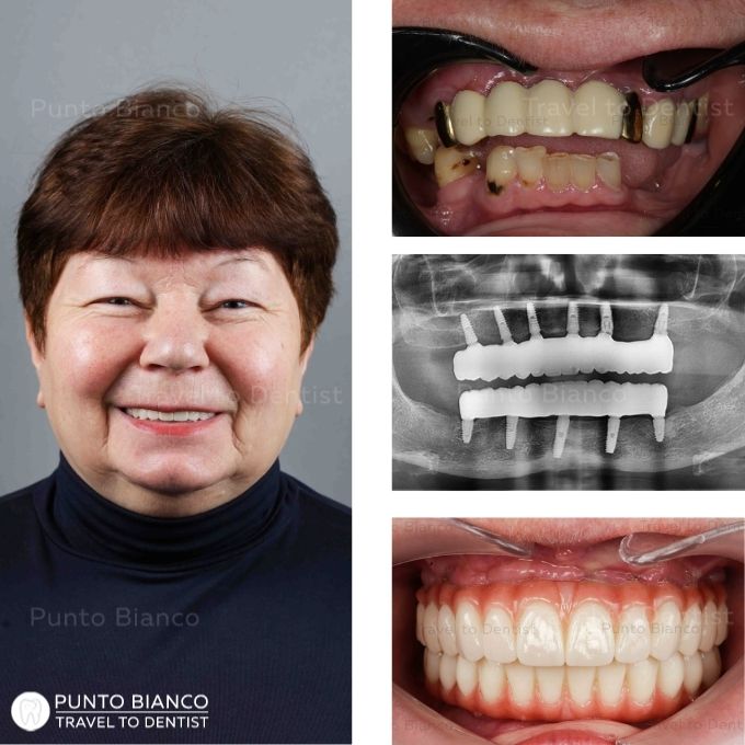 imagini inainte după implanturi all on 6 in Chisinau