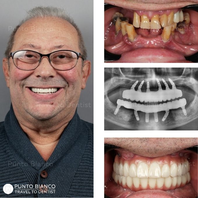 Reabilitare dentară completă în Moldova pentru turist dentar din Israel, cu dinți ficși pe implanturi și fără adiție de os