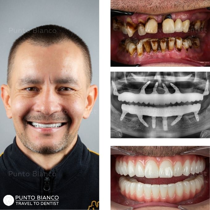 Caso antes y después All-on-6 e implantes pterigoideos