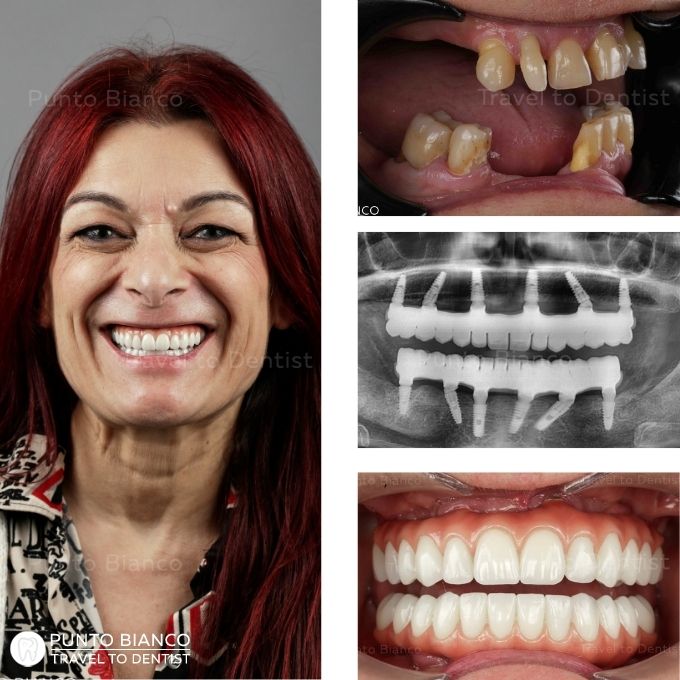 Caso antes y después tras la colocación de prótesis All-on-X de zirconio estético reforzada con barra de CrCo