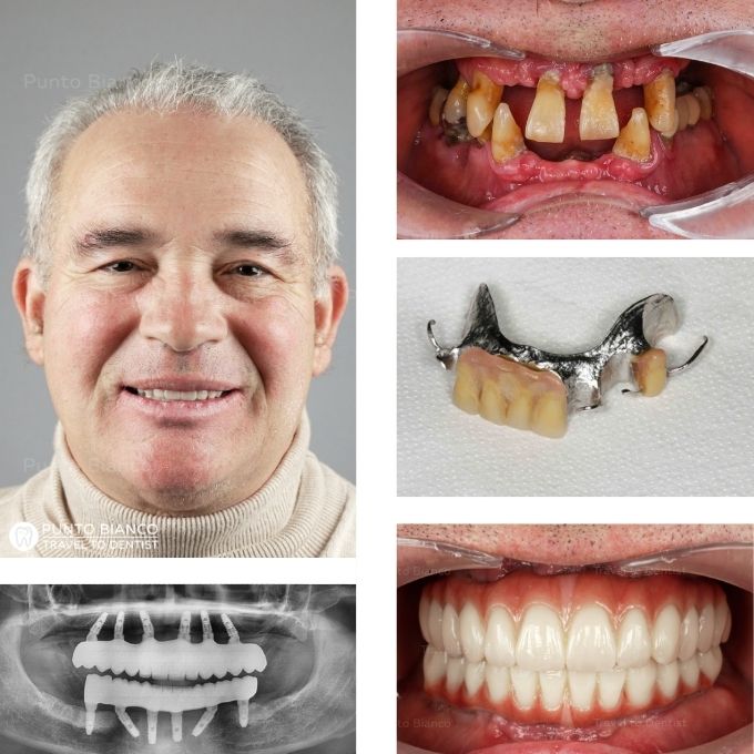 Poze de inainte și după proteza all on x din zirconiu eco intărită cu bară din titan