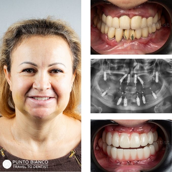 lucrare inainte si dupa protezare provizorie all on x