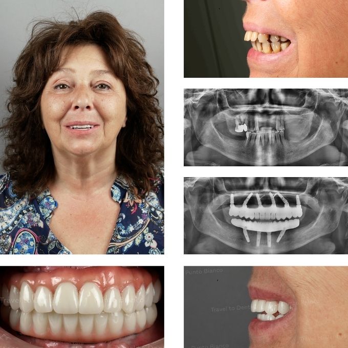 Reabilitare dentară completă în Moldova pentru pacientă din Belgia, cu înlocuirea protezelor mobile parțiale prin dinți ficși pe implanturi