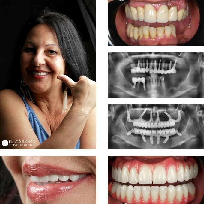 Reabilitare dentară completă în Moldova pentru o pacientă venită din Franța, cu dinți ficși pe implanturi