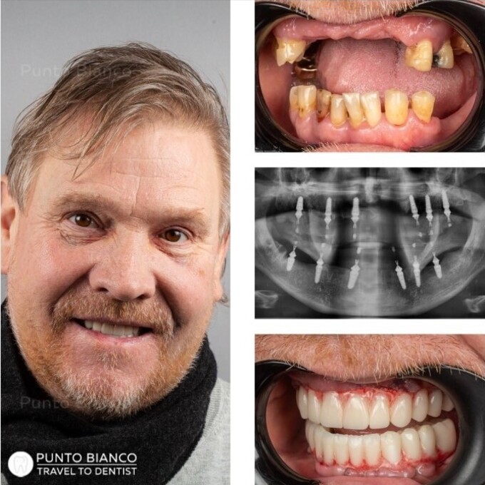 Implanturi ”toată gura” (all on 6 Megagen Anyridge) - radiografie si poze)