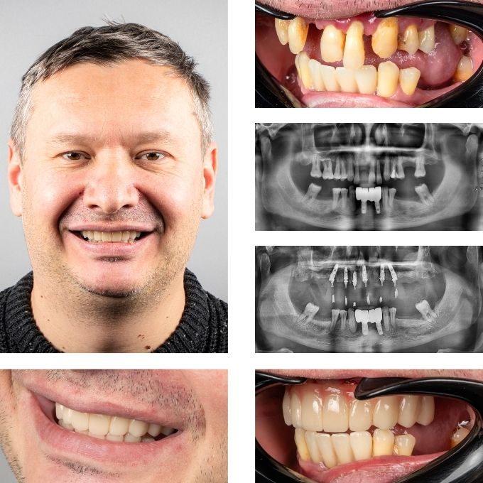 Reabilitare fixă provizorie a arcadei superioare pentru pacient din diaspora venit din Olanda, finalizată în Moldova înainte de Revelion