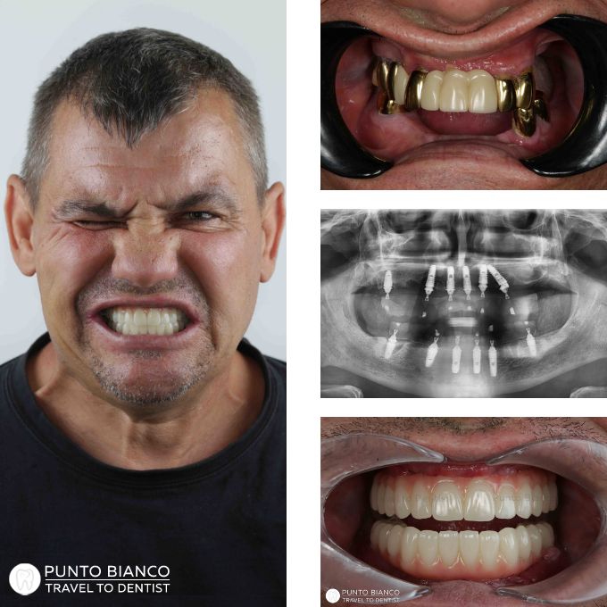 Lucrare fixă totală pe 6 implanturi, cu încărcare imediată și evitare a adiției osoase în zona laterală a maxilarului superior