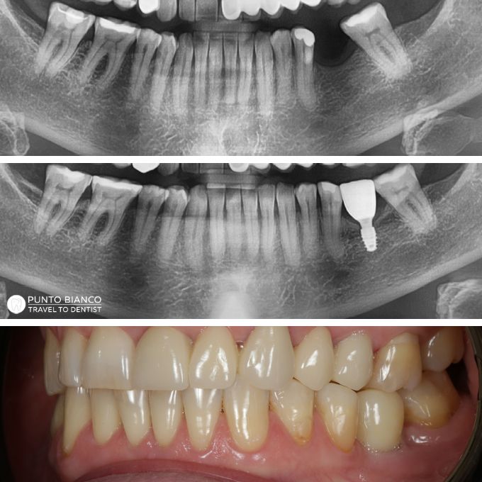 Implant Straumann Roxolid cu transplant de gingie și coroană din zirconiu, realizat în Moldova pentru un rezultat natural fără adiție osoasă