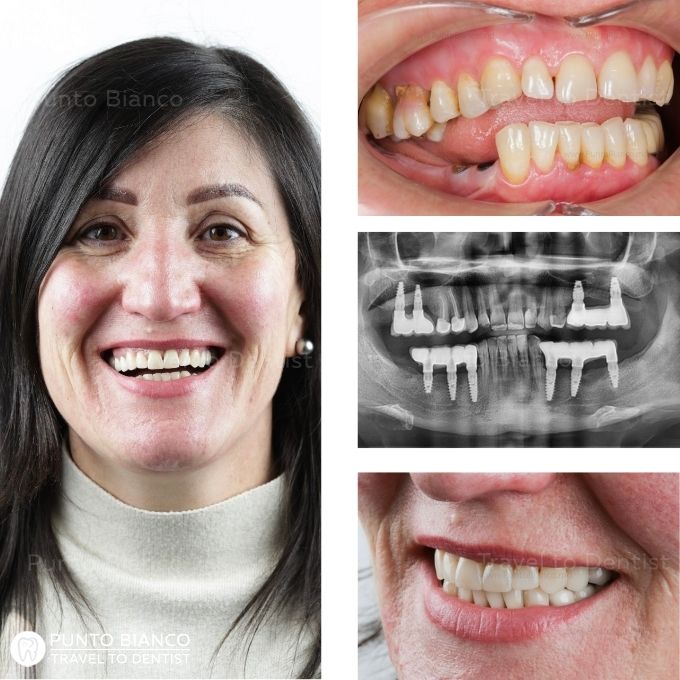 Coroana metalo-ceramica pe implant JD Evolution si coroana metalo-ceramica pe dinte