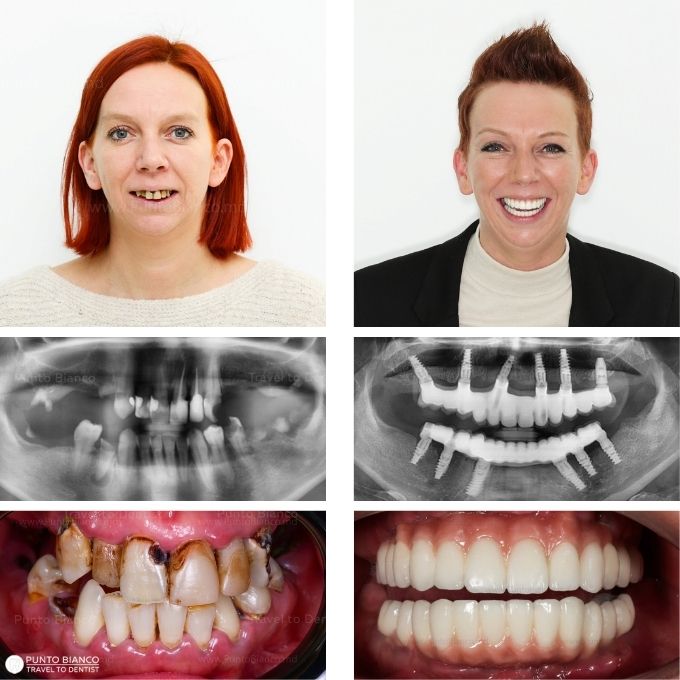 Coroană provizorie pe implant întărită cu metal in Chisinau