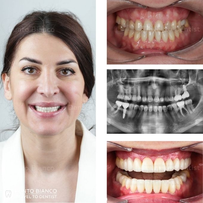 colaj foto inainte si dupa aplicarea coroanei din zirconiu-ceramica pe dinte