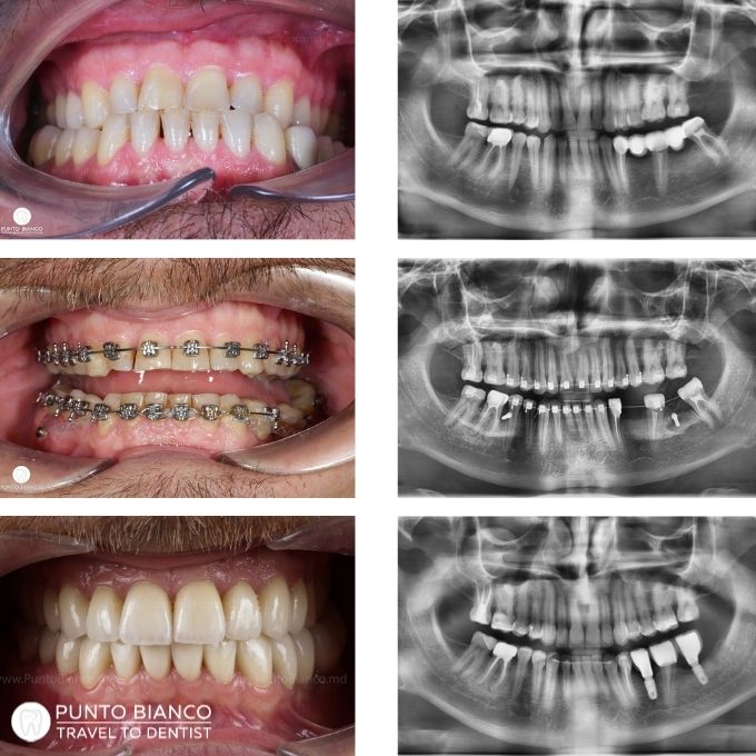 Evoluția completă a unui caz ortodontic, de la situația inițială până la rezultatul final.