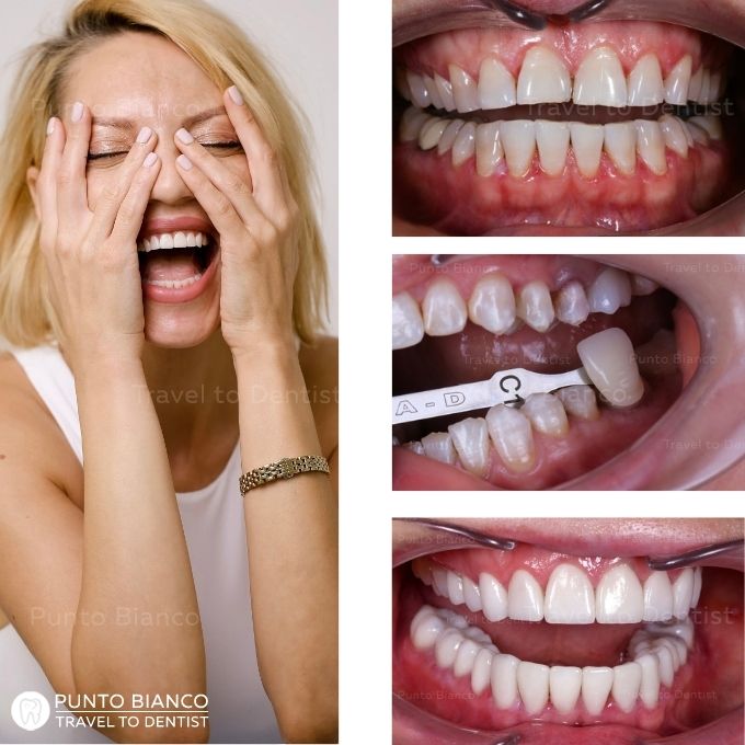 exemplu de fatete din ceramica