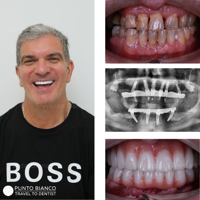 Proteza estetica din zirconiu intarita cu bara din titan (thimble)