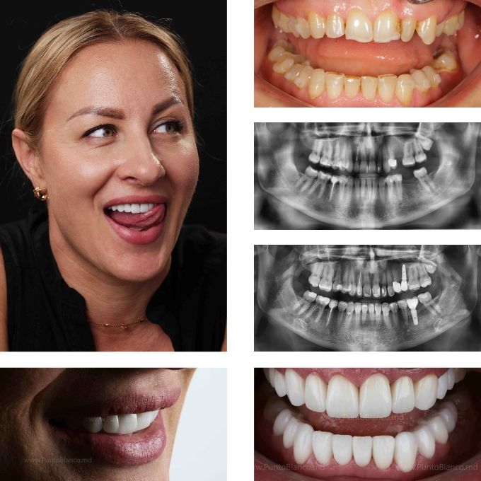 Reabilitare dentară estetică și funcțională în Chișinău, după alinierea dinților cu aligners, prin fațete și implanturi dentare