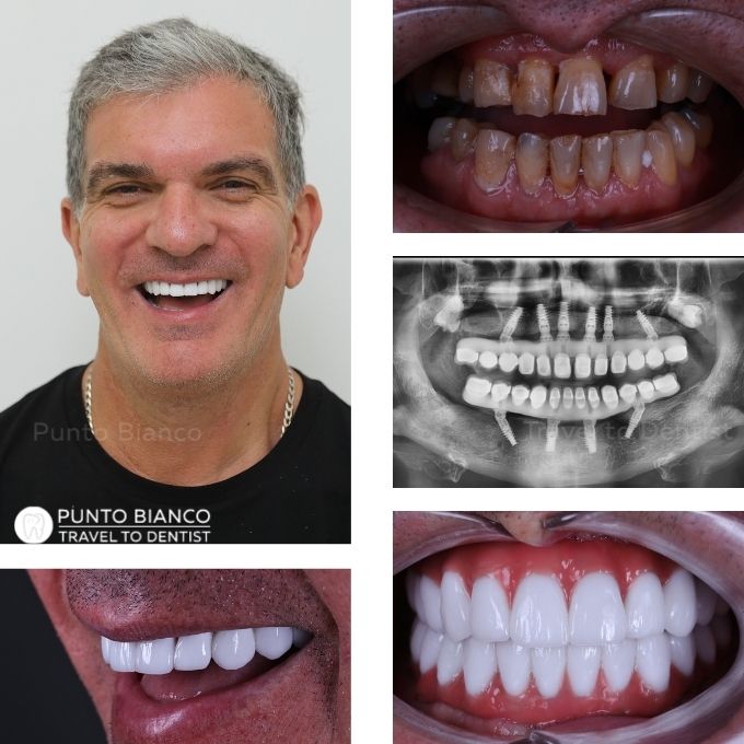 Reabilitare dentară premium în Moldova, cu All-on-6 sus și All-on-4 jos, realizată pe implanturi Nobel Biocare și proteză din zirconiu pe bară de titan