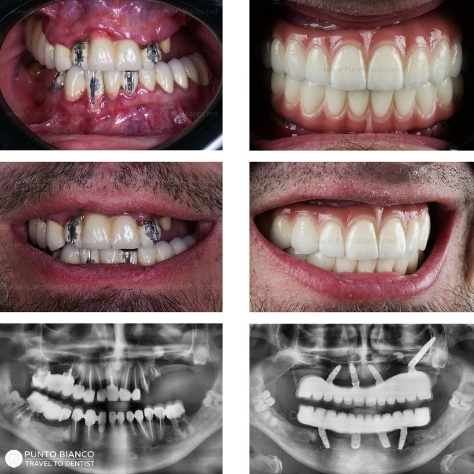 Reabilitare dentară complexă cu implant zigomatic, realizată în caz de atrofie osoasă severă și infecții multiple