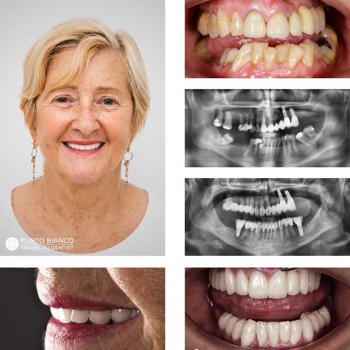 Reabilitare dentară complexă în Moldova, cu păstrarea majorității dinților naturali, implanturi dentare și restaurări din zirconiu și ceramică EMAX