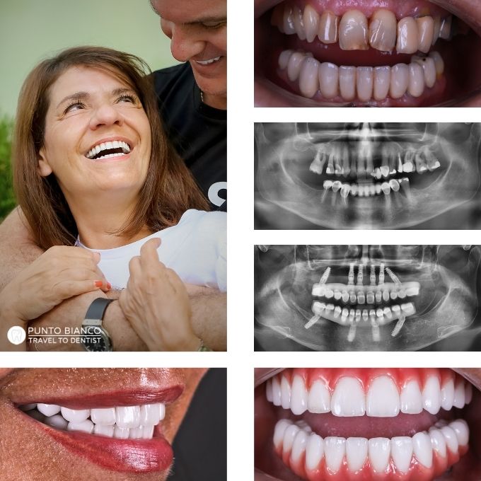 Reabilitare dentară premium în Chișinău, cu lucrări fixe din zirconiu pe implanturi, pentru un zâmbet natural și un aspect întinerit